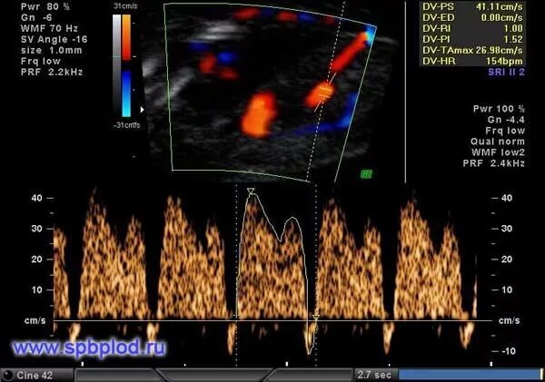 венозный проток эхограммы. кровоток в венозном протоке pi норма 13 недель. кровоток в венозном протоке ортоградный что это. кровоток в венозном протоке плода. кровоток в венозном протоке плода.