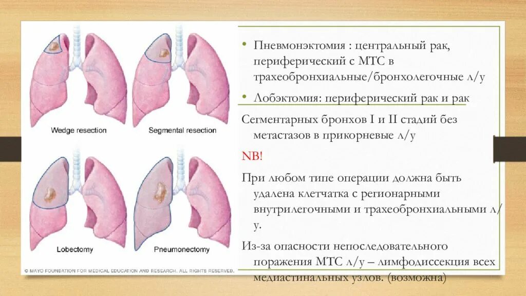 Пневмонэктомия этапы операции. Центральная и периферическая опухоль легкого. Резекция правого легкого. Лобэктомия что это