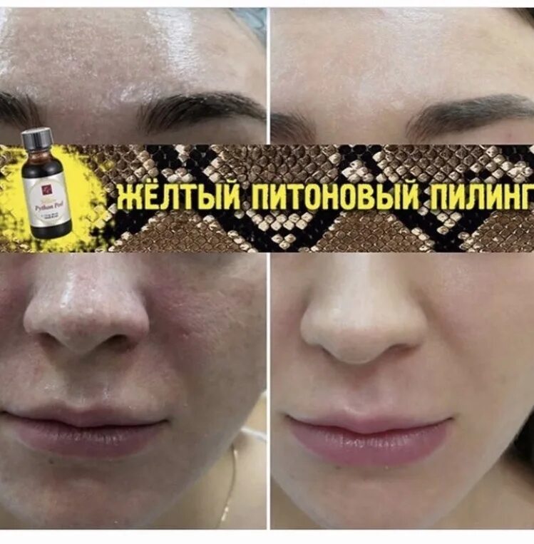 Мультифакторный пилинг LC Peel. Желтый Питоновый пилинг LC. Питоновый пилинг LC Peel