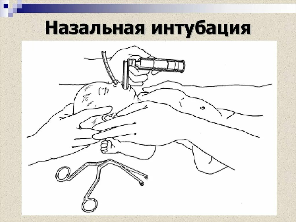 Интубация легких. Интубация трахеи эндотрахеальной трубкой. Осложнения назотрахеальной интубации. Интубация трахеи наркоз. Неинвазивная интубация.