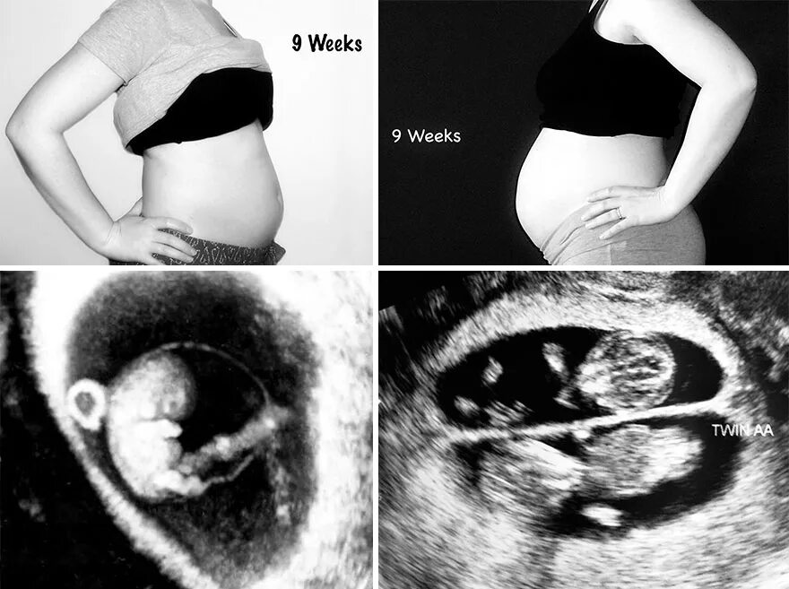 Беременность двойней по неделям. 10 Недель двойня живот. Почему на 10 неделе беременности