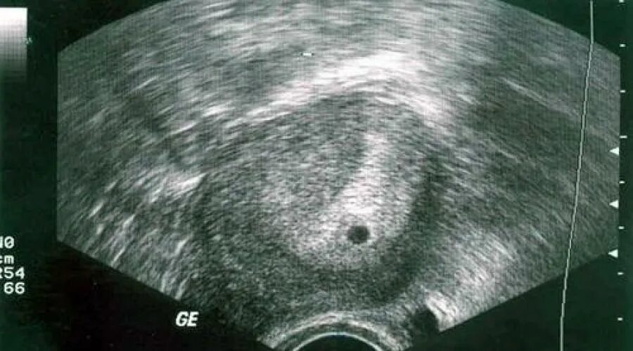 Эмбрион на 2 неделе беременности. Плод 3-4 недели беременности на УЗИ. УЗИ плода 2 недели беременности. 3 Недели беременности фото плода на УЗИ. Беременность на 2-3 недели беременности на УЗИ.