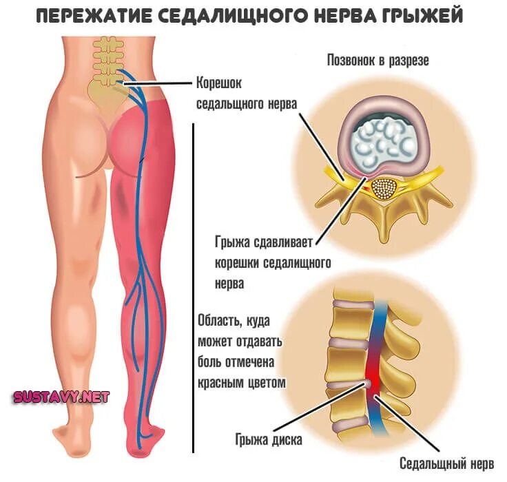 Поясница нога отнимается. Сидалеч седалищный нерв. Схема защемления седалищного нерва. Седалищный нерв анатомия схема. Защемление сидальческий нерв симптомы.