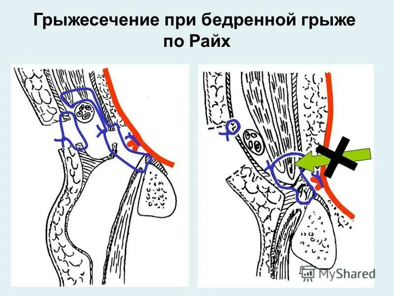 пахово бедренная грыжа у женщин. пластика бедренного канала по бассини. операция по бассини при бедренной грыже. операция бассини при бедренных грыжах. пластика бедренной грыжи.