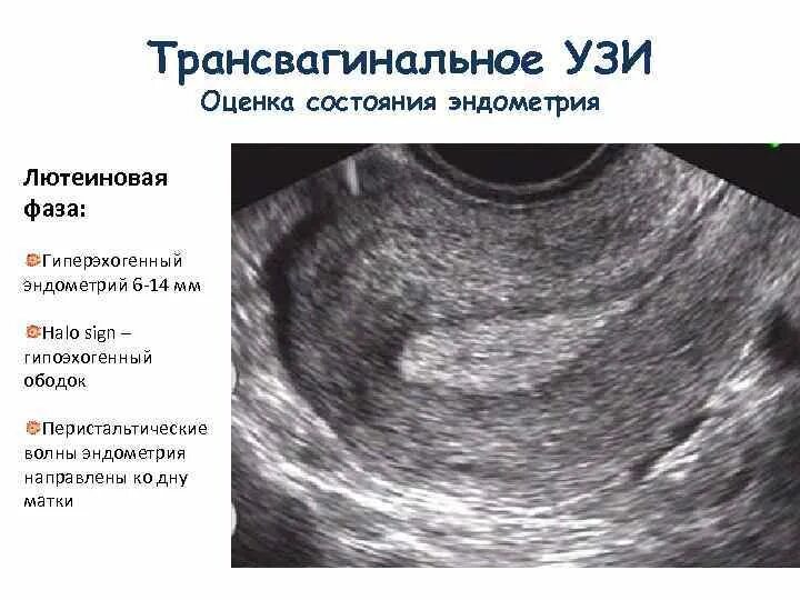 Гиперплазия полости матки. Атипическая гиперплазия эндометрия УЗИ. Гиперэхогенный полип эндометрия.