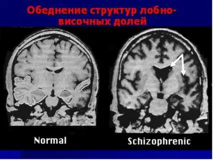 Шизофрения в 5 лет