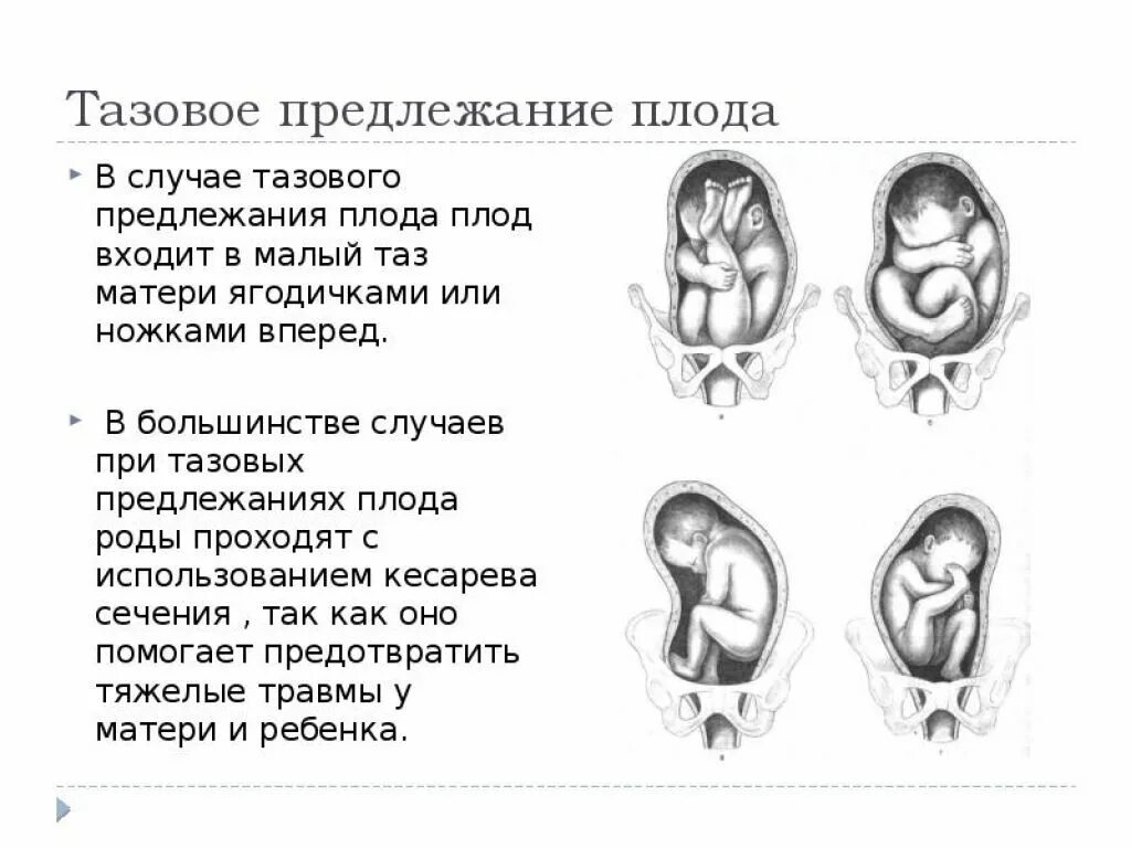 Предлежание головки. Продольное тазовое предлежание 1 позиция. продольное положение тазовое предлежание 30 недель. 34 неделя беременности ребенок в тазовом предлежании. продольное головное предлежание плода.