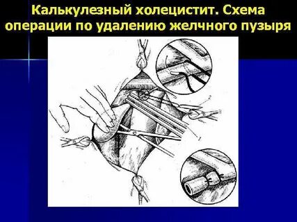Холецистит операция какая