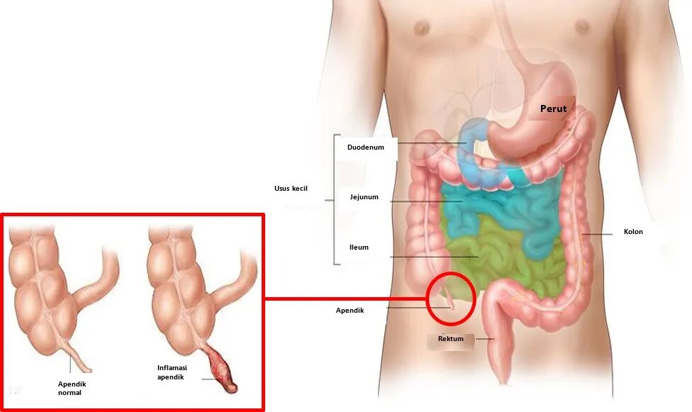 Расположение аппендицита у мужчин. Расположение аппендицита у детей. Аппендикс где находится и как болит