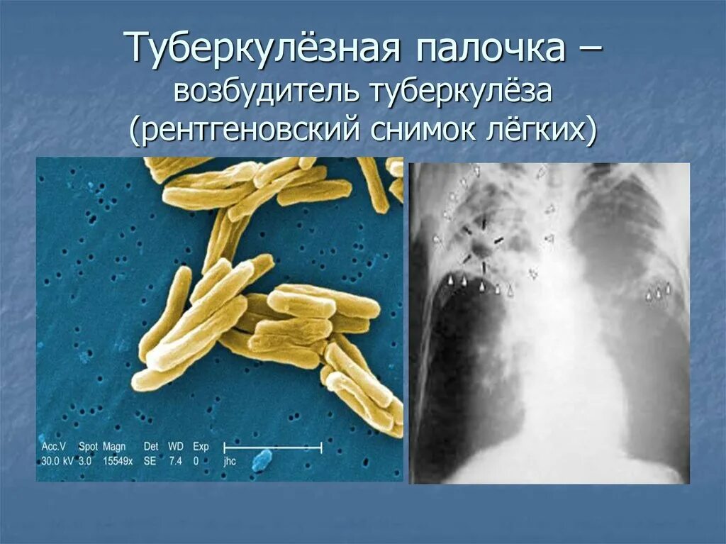 Микобактерии возбудители туберкулеза. Микобактерия туберкулеза палочка Коха. Mycobacterium tuberculosis строение. Туберкулезная палочка.
