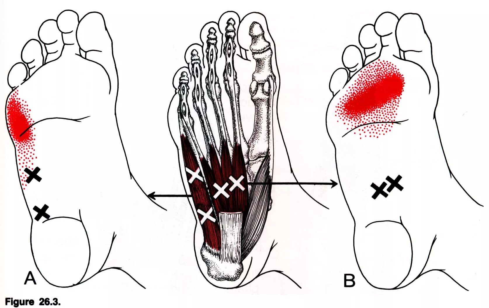 Почему болят ступни. Триггерные точки стопы. Триггерные точки мышц стопы. Триггерные точки большого пальца стопы. Триггерные точки на ступне.