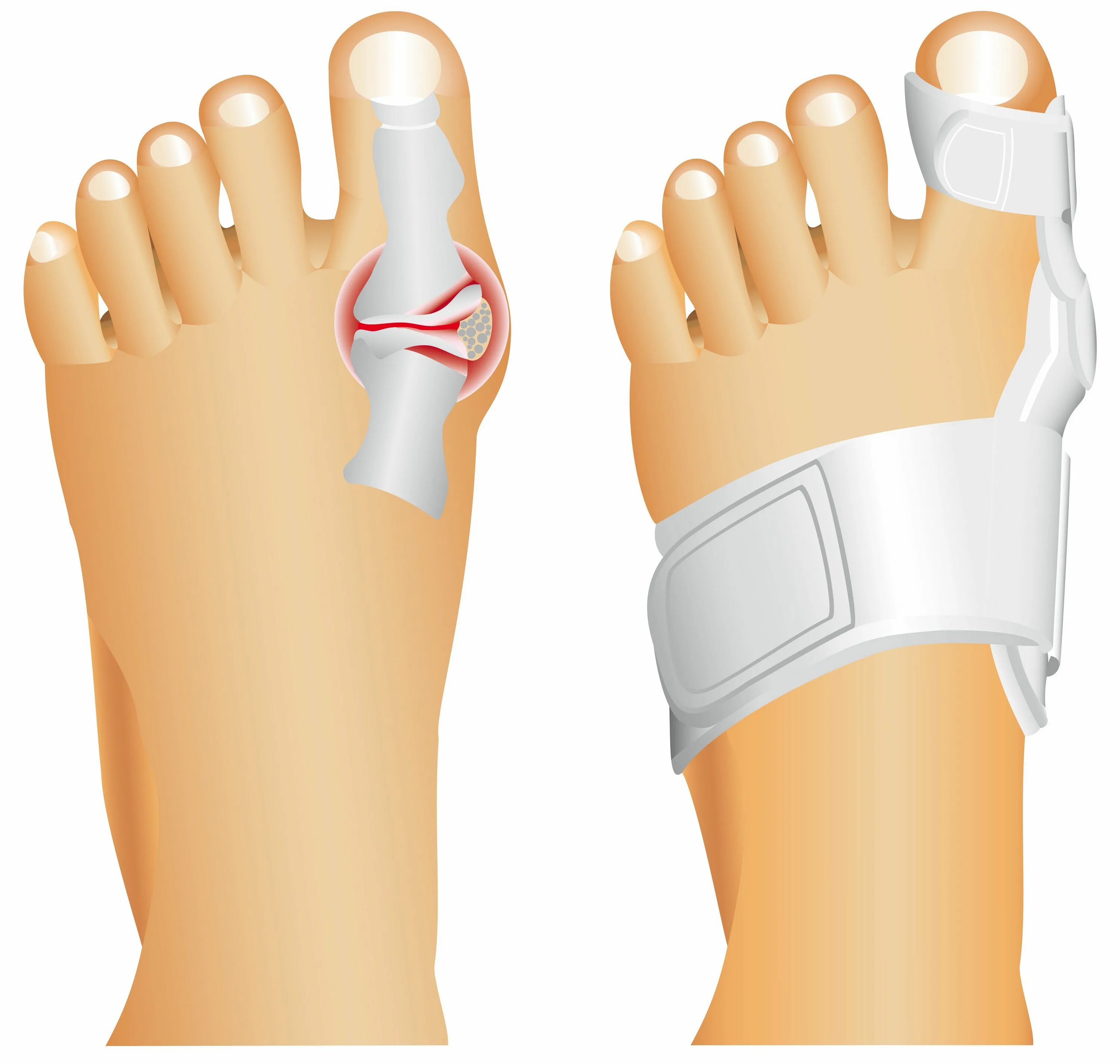 Как выглядит выбитый палец на ноге Cara Memerban Jari Tangan atau Kaki (dengan Gambar) wikiHow