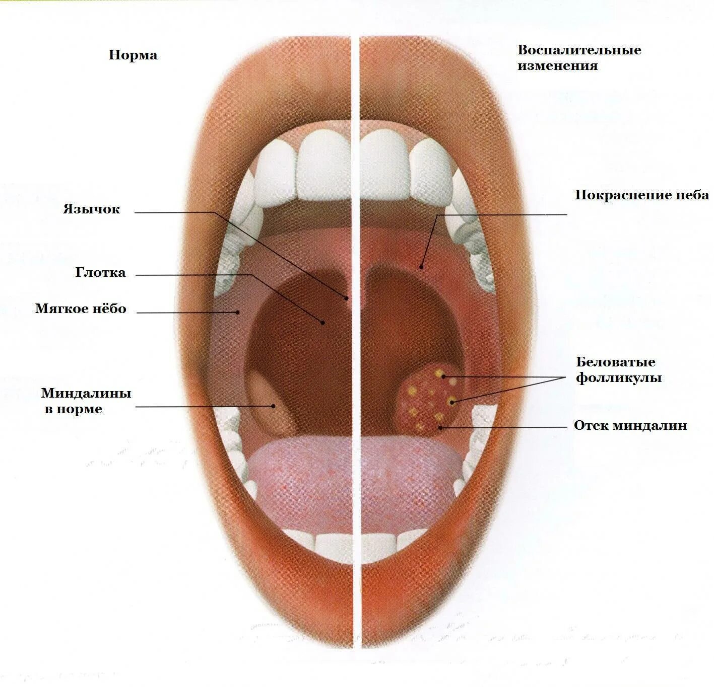 Тонзиллиты фарингиты ларингиты. Вирусная ангина комаровский. Воспаленная небная миндалина. Гнойное воспаление миндалин. Инфекционные заболевания горла.