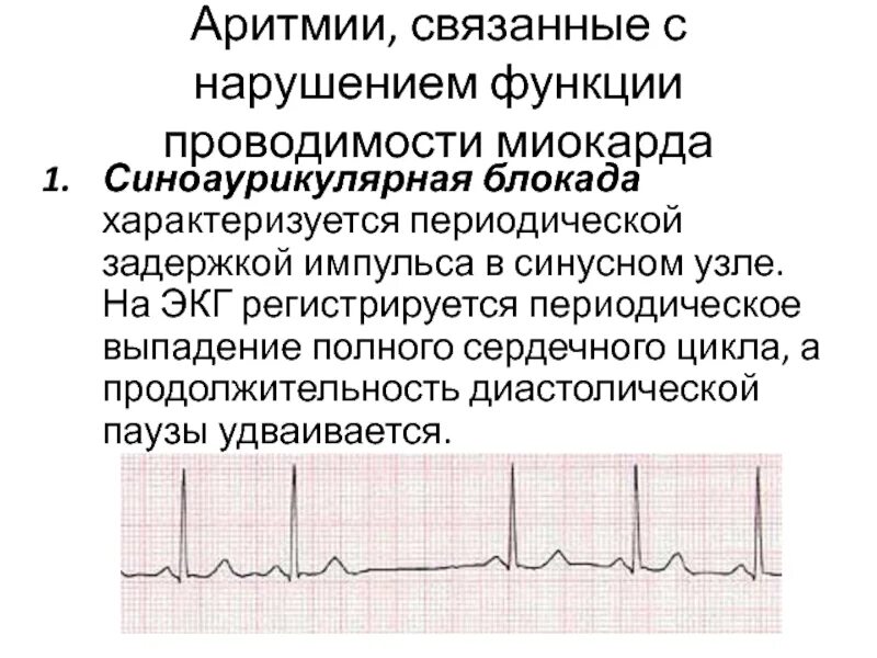 Синоаурикулярная блокада. Нарушение проводимости миокарда. Функция проводимости. Нарушения функции проводимости.