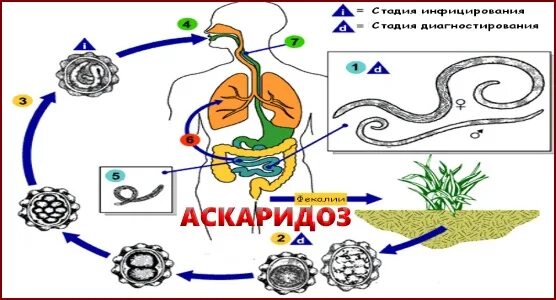 Аскариды фото у детей лечение Ascariasis is a Disease Caused by the Parasitic Roundworm Ascaris Lumbricoides f