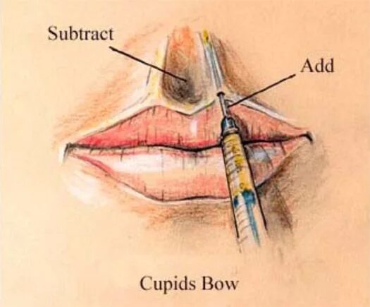 Как колоть филлер. Схема контурной пластики губ. Схема уколов в губы филлер. Техники введения филлеров в губы. Схема введения филлера в губы.