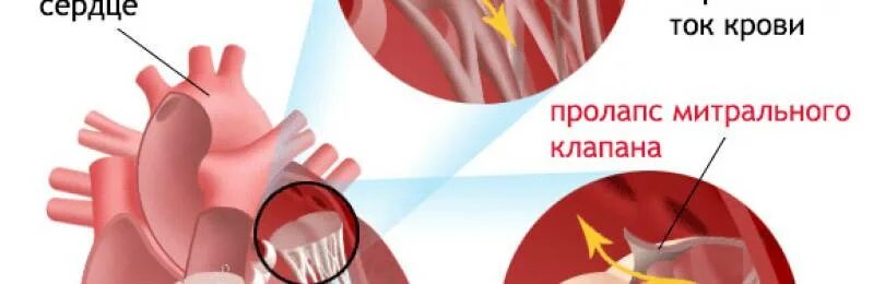 Пролапс у взрослых. Пролапс митрального клапана. пролапс митрального клапана 1. пмк 1 степени с регургитацией. пролапс митрального клапана гемодинамика.