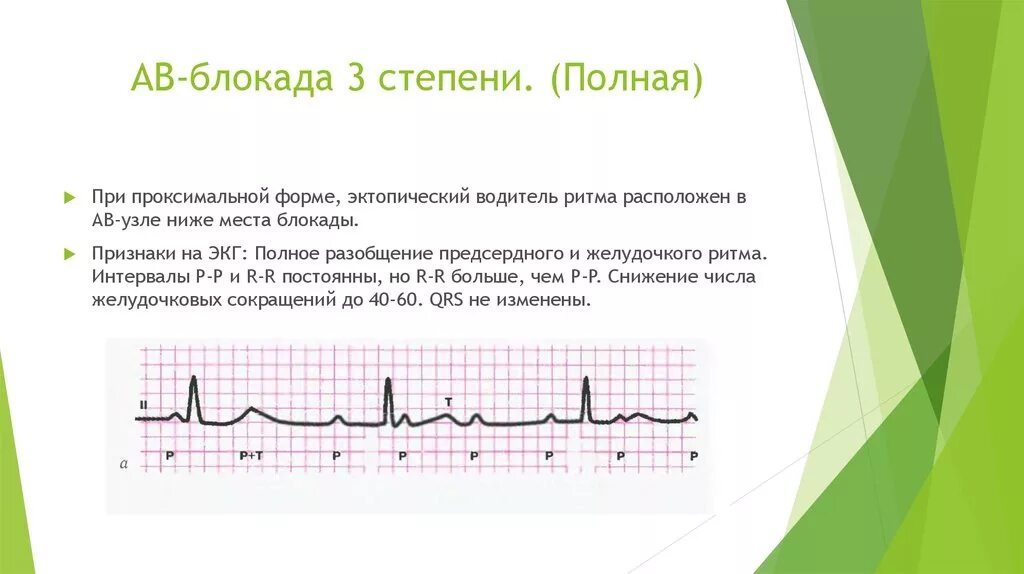 Fuller av. Полная атриовентрикулярная блокада 3 степени на ЭКГ. АВ-блокада III степени на ЭКГ. АВ блокада 3 степени на ЭКГ признаки ЭКГ. ЭКГ-критерии полной АВ-блокады.