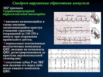 Фибрилляция предсердий карта вызова