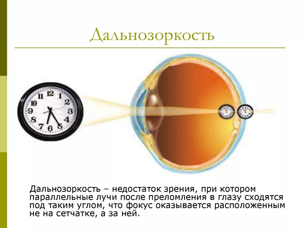 Зрения и дать решение. Дефекты зрения дальнозоркость. Гиперметропия острота зрения. Глаз. Дефект зрения.. Дефекты зрения и их исправление.