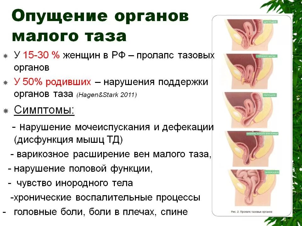 Опущение органов форум. Опущение органов малого таза. опущение органов малого. опущение и выпадение органов.