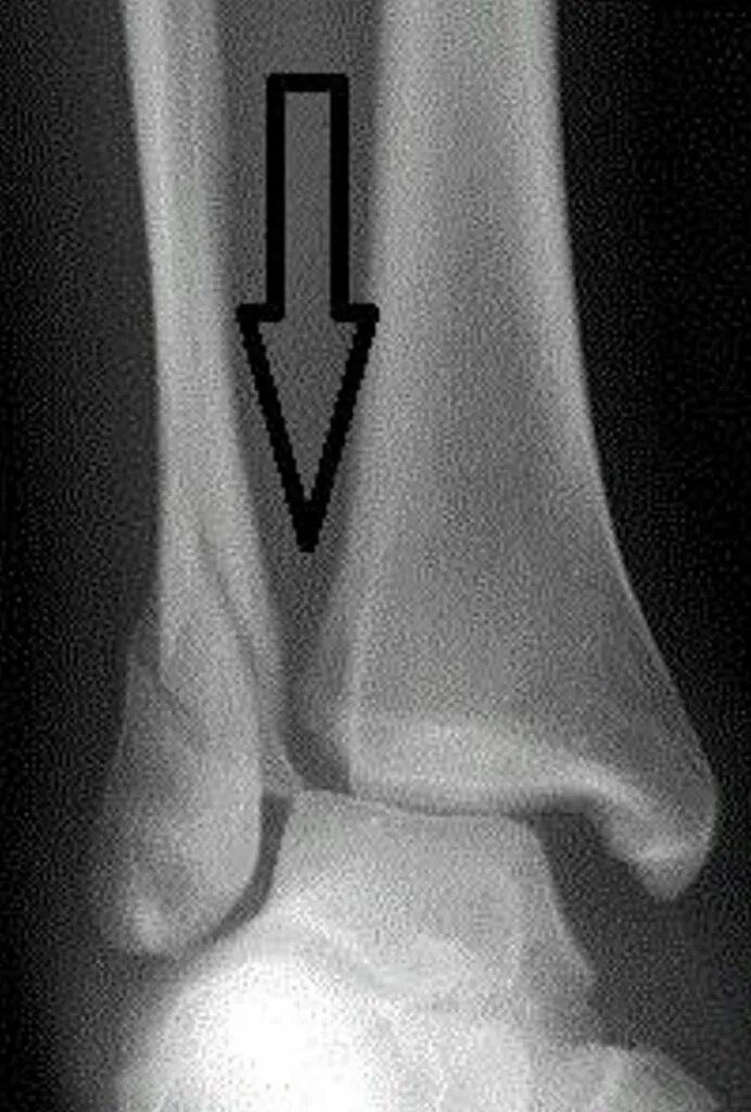 Дистальный разрыв. Межберцовый синдесмоз норма. Синдесмоз голеностопного сустава. Перелом лодыжки синдесмоз. Разрыв синдесмоза голеностопного сустава рентген.