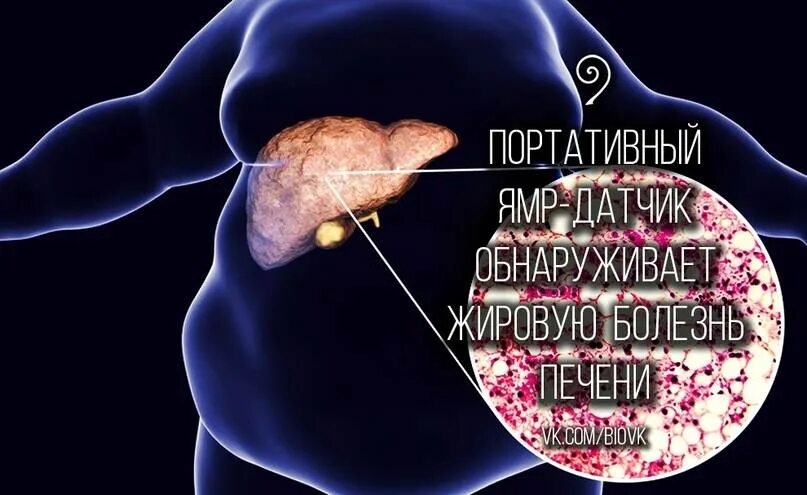 Диффузные изменения печени признаки жирового гепатоза. Неалкогольный жировой гепатоз печени. жировой гепатоз поджелудочной железы.