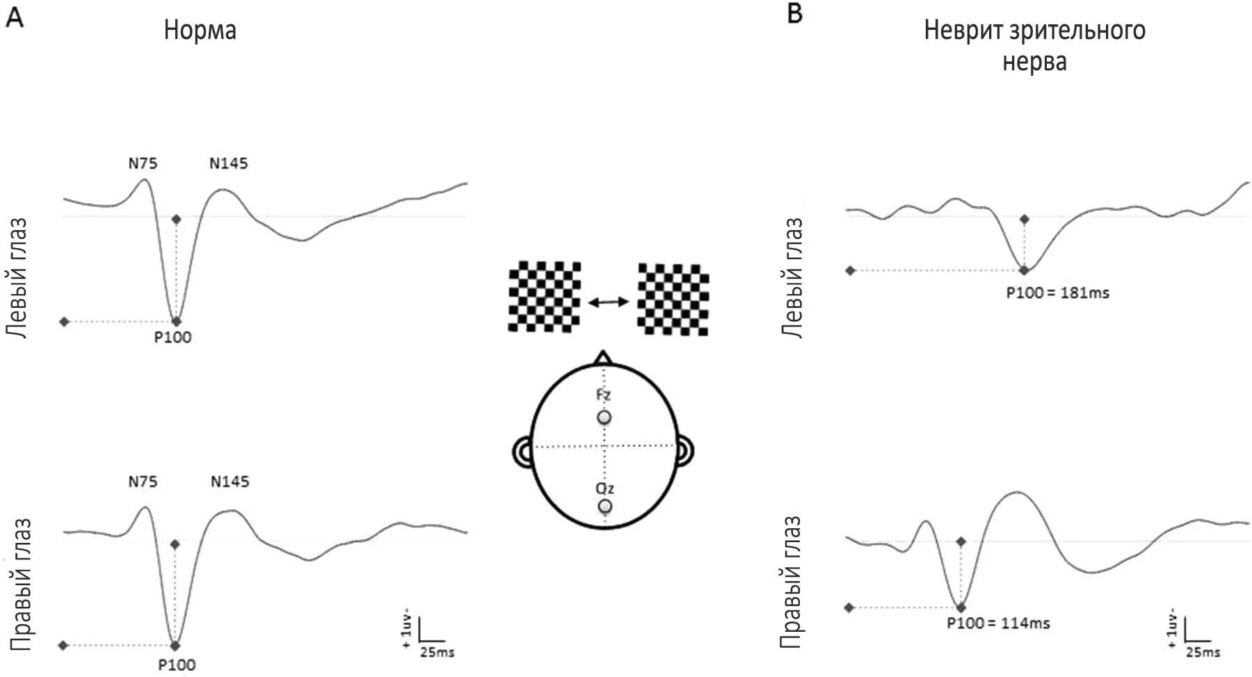 Потенциал ээг. Зрительные вызванные потенциалы на ЭЭГ. Зрительные вызванные потенциалы в офтальмологии норма. Р100 зрительный вызванный потенциал. Зрительно вызванные потенциалы норма.