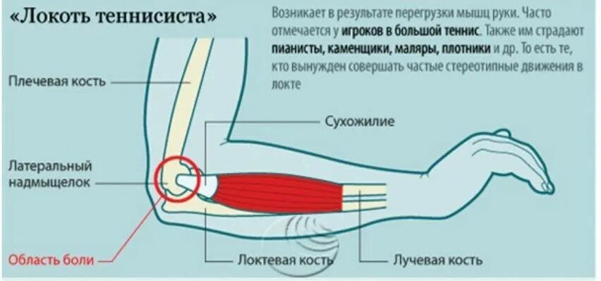 Болят локти причина и лечение у женщин. Эпикондилит локтевого сустава. Латеральный эпикондилит локтевой кости. Медиальный эпикондилит сухожилия. Латеральный или медиальный эпикондилит.