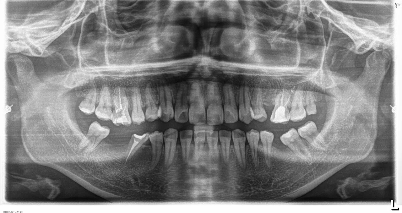 Потеря зуба и осложнения. Последствия утраты зуба.