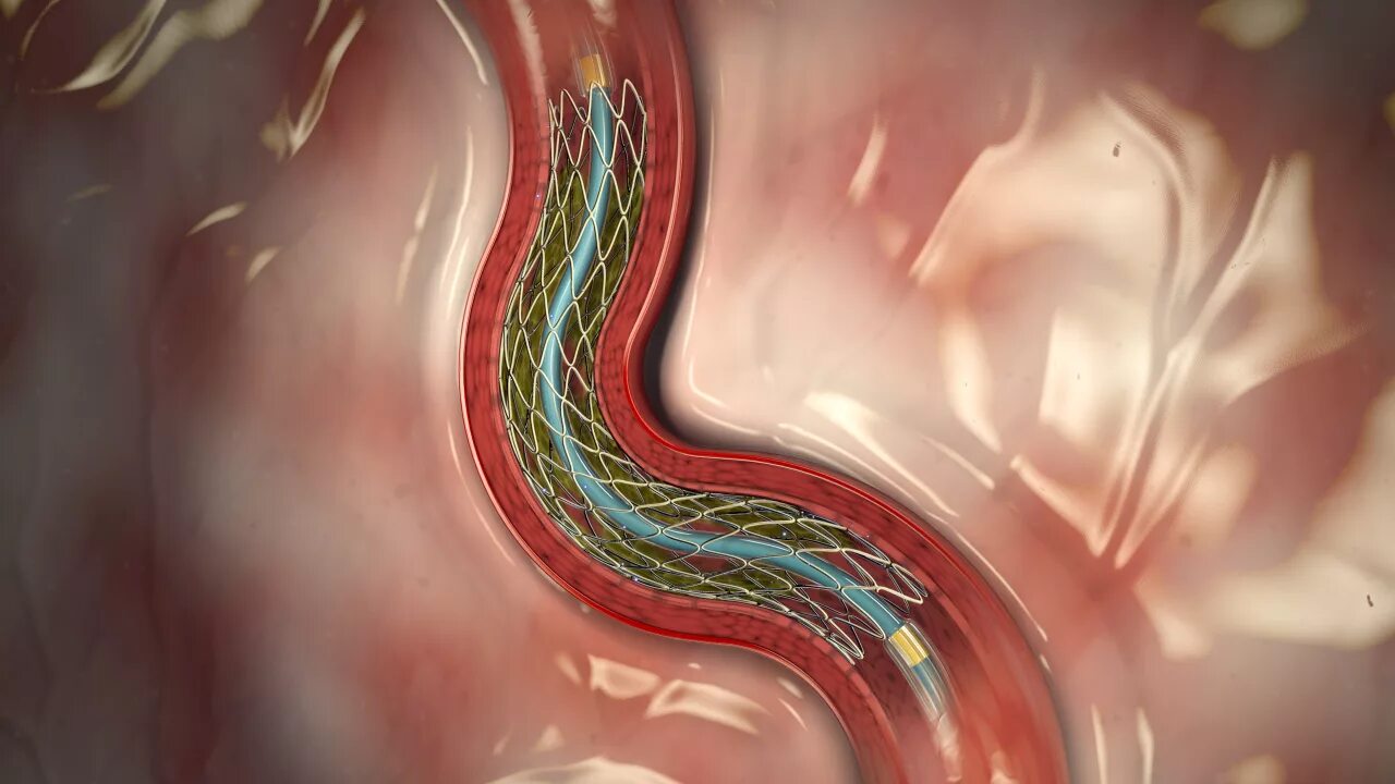 Стентирование рекомендации. Шунтирование и стентирование. Коронарное стентирование. Атеросклероз стентирование.