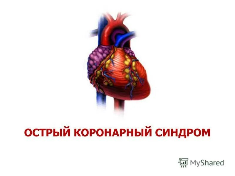 Костовый оронарный синдром. Острый коронарный синдром сердце. Острый коронарный синдром сердце. Острый коронарный синдром этиология. Острый коронарный синдром (окс).