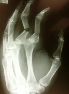 Broken finger