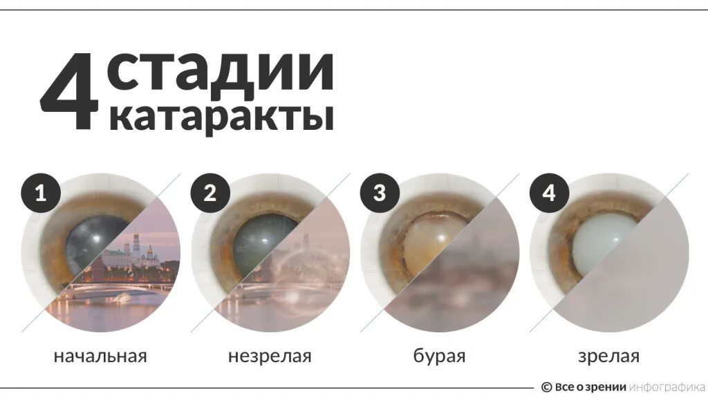 Развитие катаракты симптомы. Катаракта схема глаза. стадии зрелости катаракты. катаракта по степени помутнений.