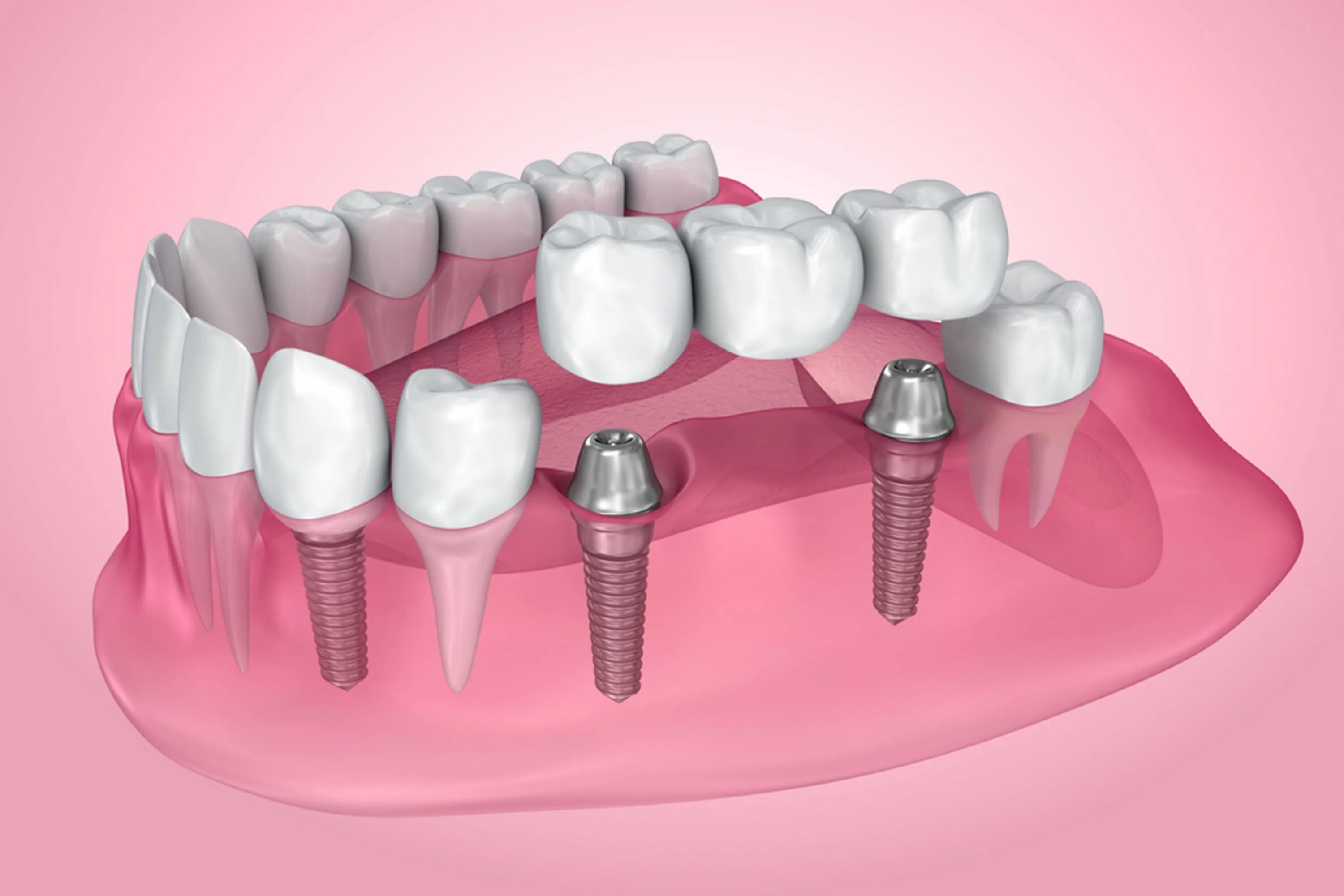 Три стоматолога. Имплантация коренных зубов. Импланты жевательных зубов.