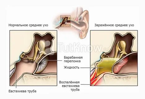 Лечение заложенности ушей после
