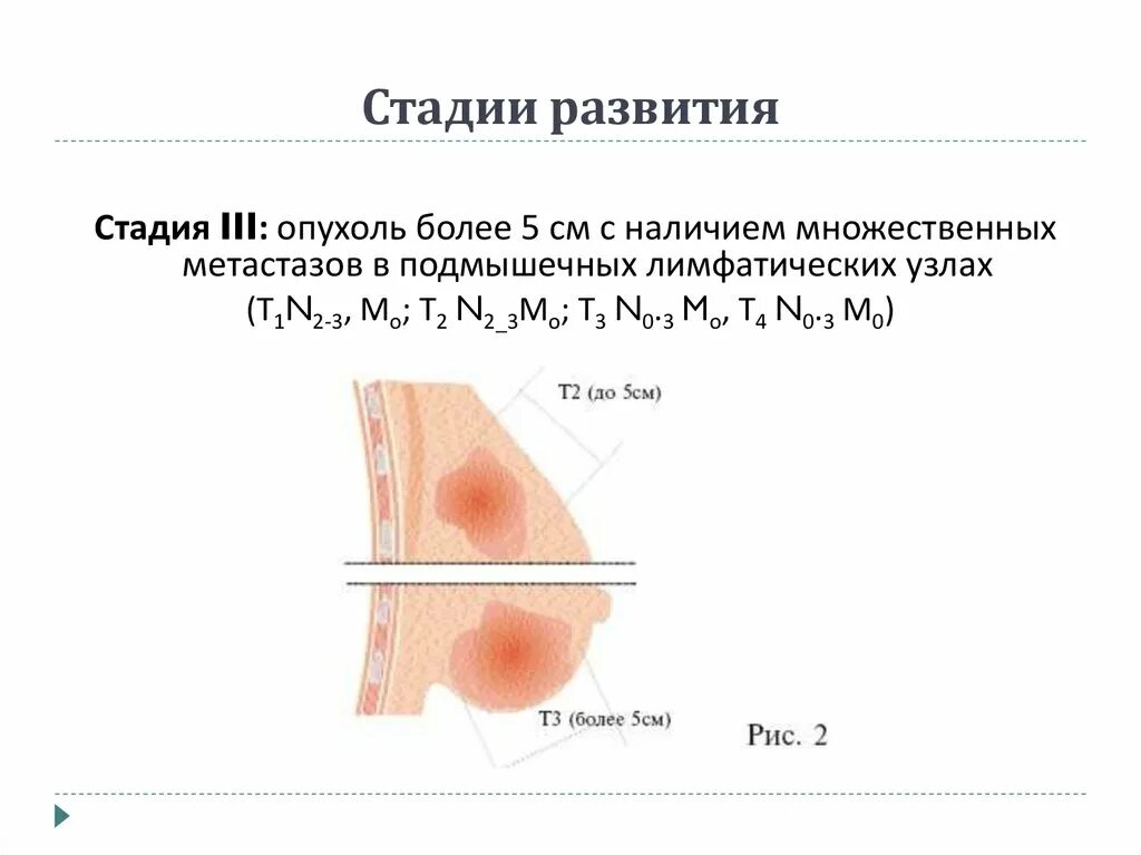 Как выглядит рак 3 стадии Рак легких Арт Минск.ру
