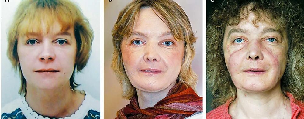 Люди до и после пластики лица. Кореянка до и после пластической операции. Пластическая операция подтяжка лица. Донателла версаче филлеры. Кореянки без макияжа и операций.