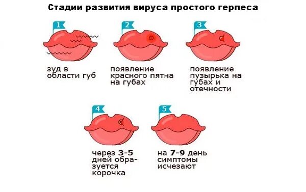 Герпес стадии развития. Стадии герпеса по дням. Стадии герпеса по дням. Герпес на губе на ранней стадии. Стадии герпеса по дням.