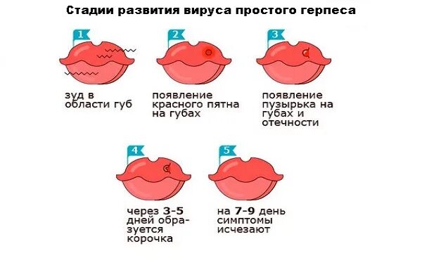 Герпес стадии развития. Герпес на губах начальная стадия.