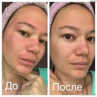 Можно ли маски после пилинга