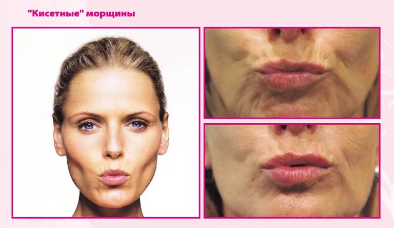 Smoker’s Lines / Perioral Line Filler - Derma Models in 2019 Smokers lines, Boto