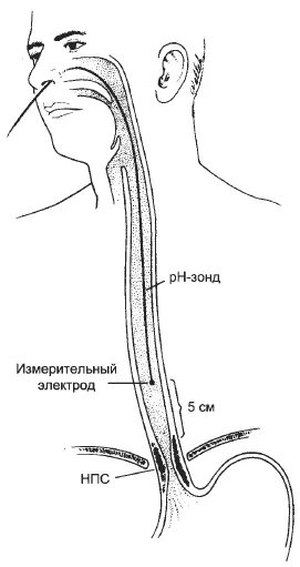 Зонд через нос