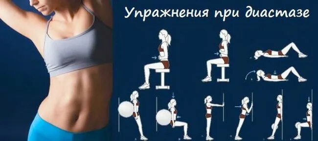 Упражнения при диастазе мышц. Упражнения при диастазе мышц. Комплекс упражнений для пресса при диастазе. Упражнения на пресс при диастазе. Упражнения при диастазе мышц.