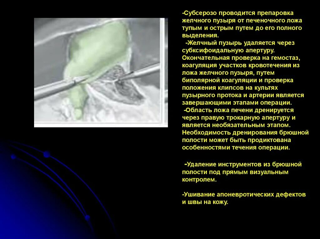 Операция по удалению желчного пузыря анализы. Коагуляция ложа желчного пузыря. Ушивание ложа желчного пузыря. Жидкость в ложе желчного пузыря.