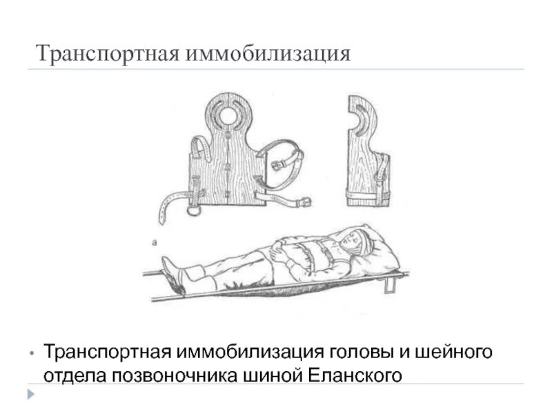 Транспортная иммобилизация при переломе шейного отдела позвоночника. Транспортная иммобилизация шейного отдела позвоночника. Иммобилизация при переломе шейного отдела позвоночника. Транспортная иммобилизация шиной башмакова. Иммобилизация при переломе шейного отдела позвоночника.