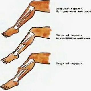 Перелом со смещением какая операция