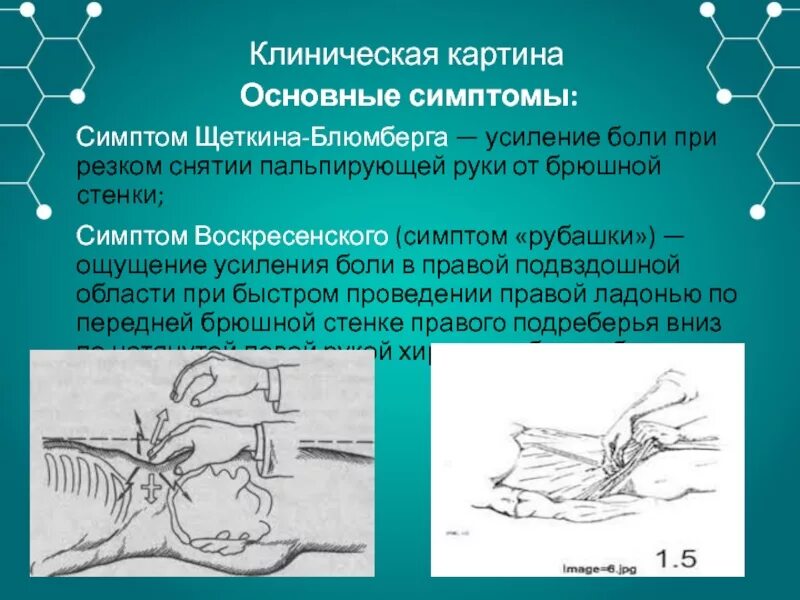 Аппендицит блюмберга симптомы. Симптом щеткина блюмберга. симптом зеткина блюм.ерга. симптом шиткина ломбера. симтом щетуина блюмбеонп.
