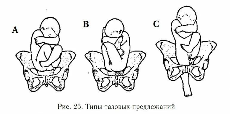 Тазовое предлежание плода кесарево. Ребенок в тазовом предлежании. Тазовое предлежание плода. Рождение в тазовом предлежании.