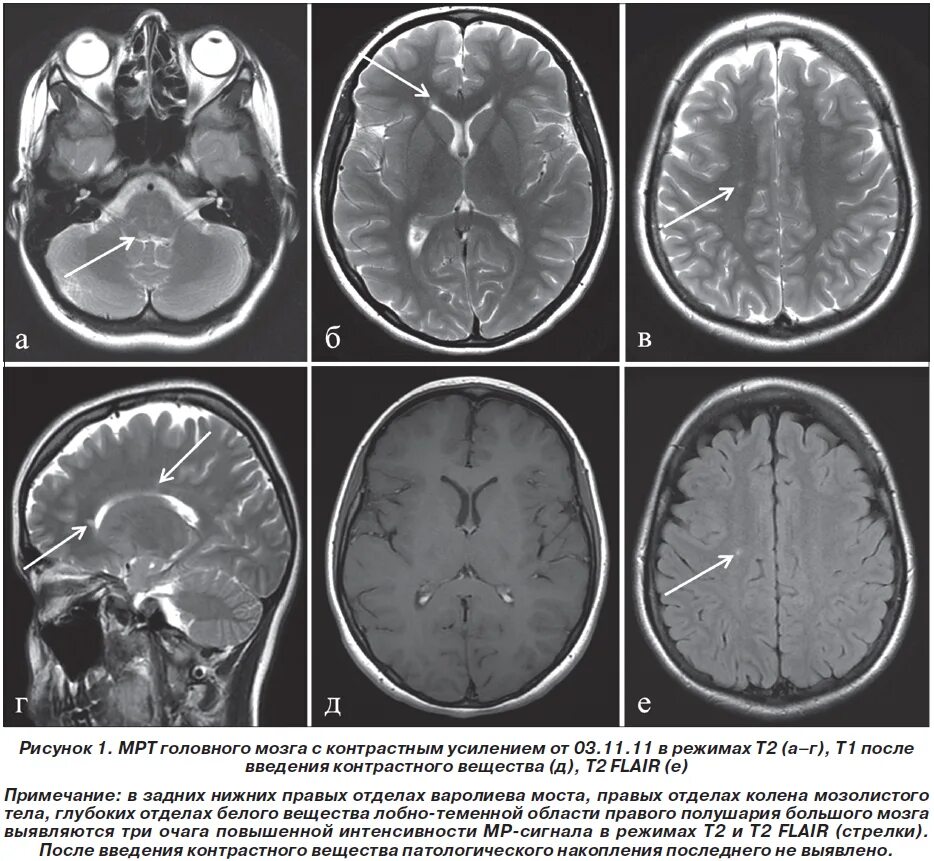 Мрт с контрастом головного. Мрт головного мозга контрастирование. Снимки кт головного мозга контрастирование. Опухоль головного мозга на кт без контраста. Что такое контрастирование при мрт головного мозга.